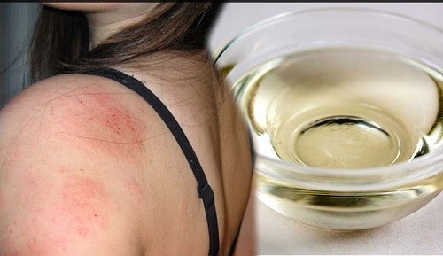 chữa bệnh chàm bằng dầu dừa