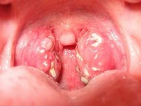 7 nguyên nhân không ngờ gây ung thư vòm họng có thể bạn cũng mắc