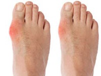 Những dấu hiệu sớm giúp bạn nhận ra mình bị bệnh gút