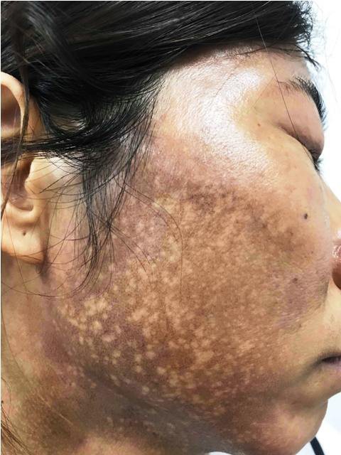 Hãi hùng mặt lở loét, mọc đầy lông vì dùng kem trộn chữa trứng cá, nám má - Ảnh 3. Hãi hùng mặt lở loét, mọc đầy lông vì dùng kem trộn chữa trứng cá, nám má - Ảnh 3.