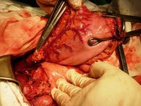 Căn bệnh nguy hiểm gây tử vong hàng đầu tại Việt Nam