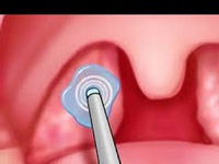 Ung thư vòm họng giai đoạn đầu có biểu hiện gì?