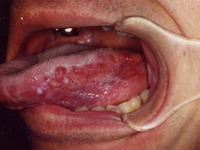 Dấu hiệu bất thường ở lưỡi phải đi khám ngay kẻo ung thư