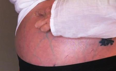 Bai-thuoc-tri-xo-gan-co-truong-voi-gung-gio1