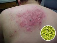 Sai lầm phổ biến trong điều trị bệnh zona (giời leo)