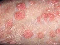 Mắc sùi mào gà từ ông chủ, thiếu nữ hốt hoảng vì loét miệng