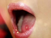 Mẹo trị nhiệt miệng thần tốc ngay tại nhà
