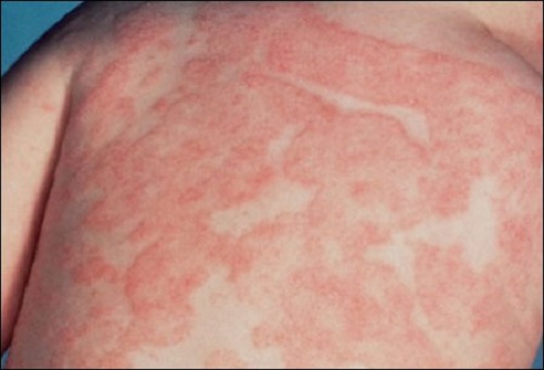 thuoc-tri-cham-boi-nhiem-2