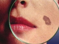 5 đặc điểm của nốt ruồi chứng tỏ bạn đã bị ung thư da