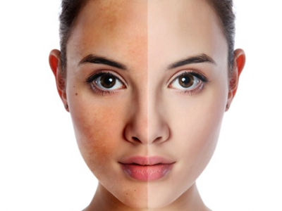 cach-tri-nam-da-mat-cho-phu-nu-tuoi-301