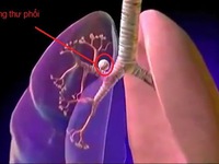 Dấu hiệu cấp báo phổi bạn có thể đã bắt đầu hỏng