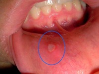 Trị nhiệt miệng “cấp tốc” không cần đến thuốc