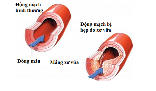 Xơ cứng động mạch - cơ thể đã lên tiếng nhiều hơn về việc thiếu collagen rồi đấy