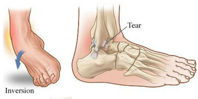 Trật mắt cá chân
