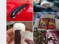 Thực hư ca phẫu thuật toàn đỉa tại BV Bạch Mai