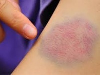 Chảy máu suốt 3 năm vì ăn thịt chó