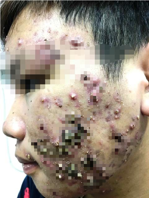 Hãi hùng mặt lở loét, mọc đầy lông vì dùng kem trộn chữa trứng cá, nám má - Ảnh 2. Hãi hùng mặt lở loét, mọc đầy lông vì dùng kem trộn chữa trứng cá, nám má - Ảnh 2.