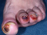 Trắc nghiệm 5 phút: Bạn có nguy cơ mắc bệnh tiểu đường không?