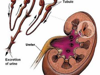 Những lý do nghiêm trọng khiến người Việt rất dễ mắc sỏi thận?