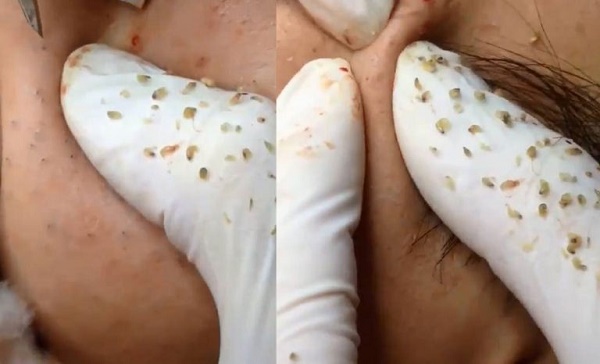 Sự hình thành và phát triển của mụn đầu đen đối với da mặt con người