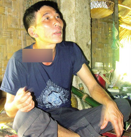 Phương pháp nối xương lạ kỳ gãy một nơi bó một nơi - Ảnh 2 Phương pháp nối xương lạ kỳ gãy một nơi bó một nơi - Ảnh 2