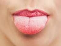 Khi thấy lưỡi có biểu hiện sau, phải đi khám ung thư ngay