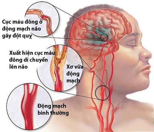 Mất ngủ dẫn đến tai biến mạch máu não