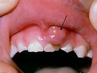 Nguyên nhân không ngờ gây nên bệnh ung thư miệng