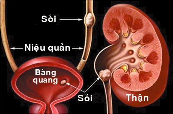 Kim tiền thảo trị sỏi thận
