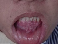 Sùi mào gà  bệnh nguy hiểm phải chung sống suốt đời