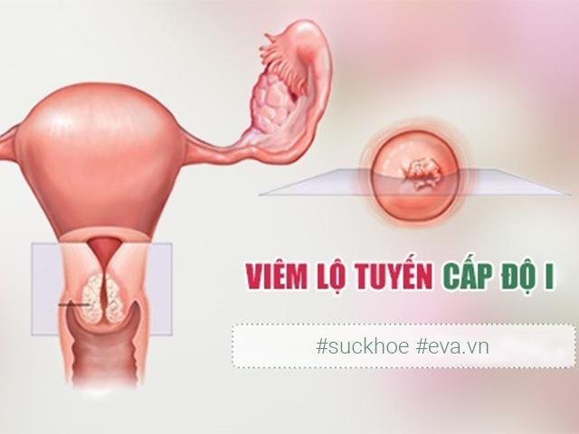 khi hu bat thuong, can than keo mac viem lo tuyen co tu cung do 1 - 1