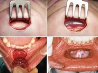 Cận cảnh ca phẫu thuật độn cằm đau đớn, nhiều nguy hiểm