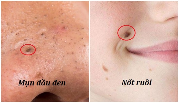 Sự hình thành và phát triển của mụn đầu đen