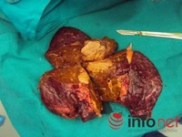 Gan xơ như xỉ than của tiên tửu