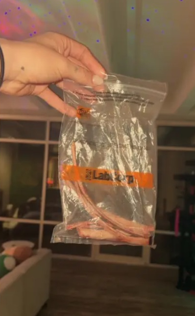 Phần xương sườn được cắt bỏ của Emily James. Ảnh: Emily James